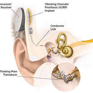 使用植入式助听器的注意事项