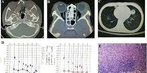 顽固性中耳炎-中篇
