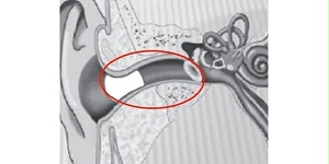 戴上助听器，“嗡嗡嗡”怎么办？