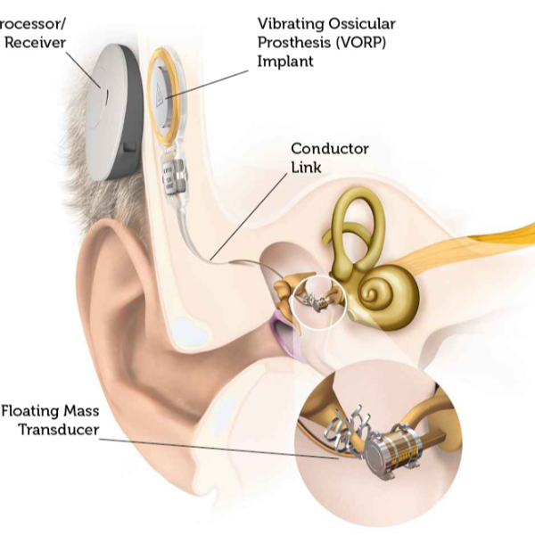 使用植入式助听器的注意事项