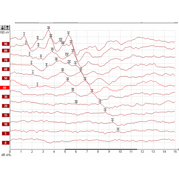 如何看待电反应测听的检测结果？