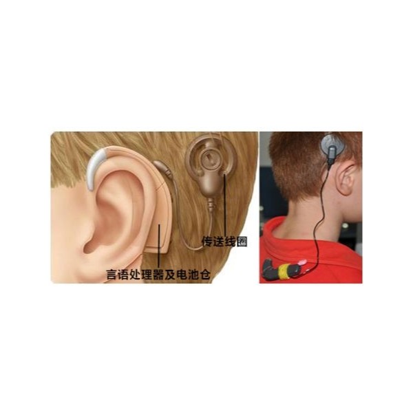 耳蜗死区对听觉会有什么影响？