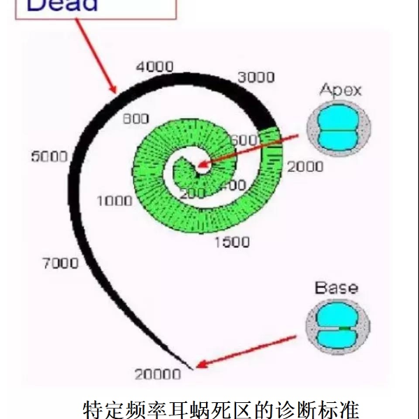 如何识别或鉴定耳蜗死区？