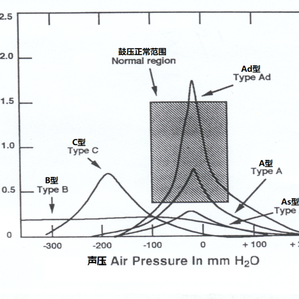 如何看懂声导抗检测报告中的鼓室压图？