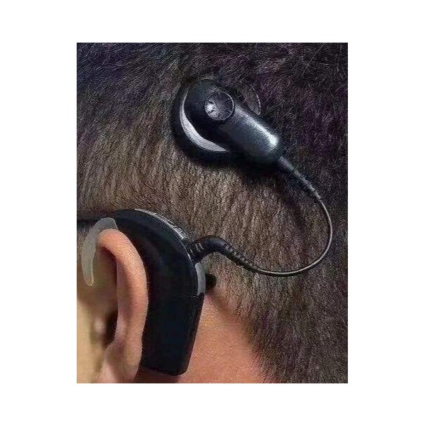 电子耳蜗的禁忌症是什么？